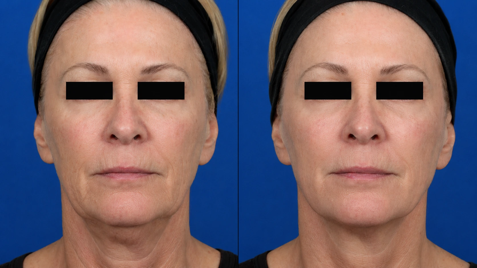 Before and after TempSure Envi full face treatment