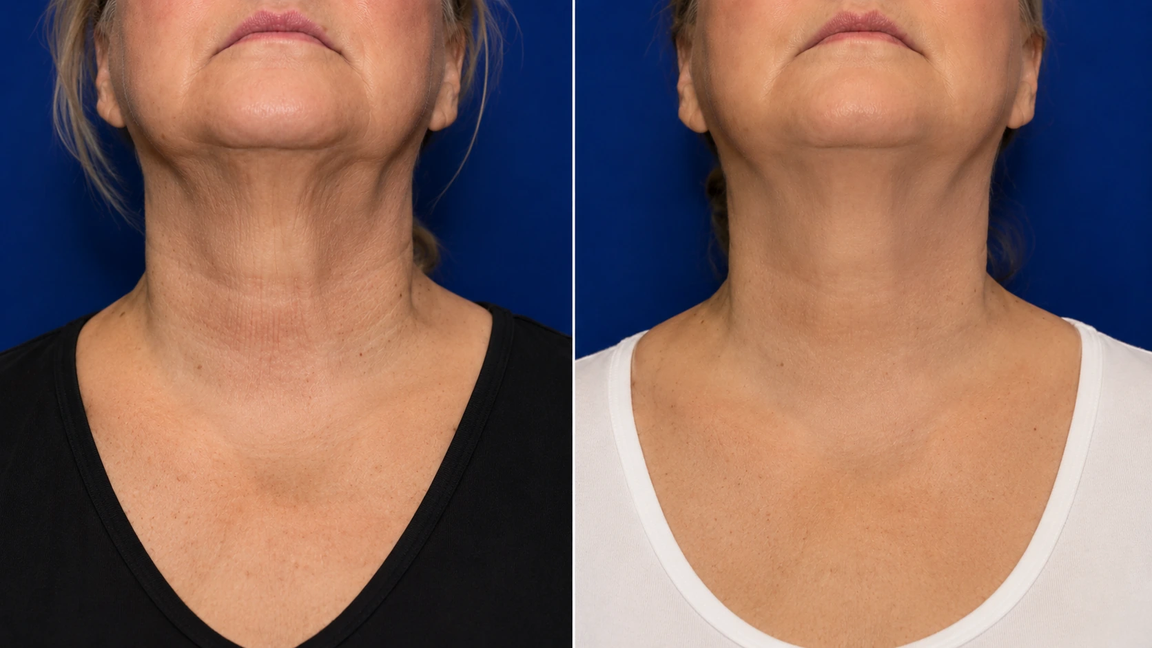 Before and after TempSure Envi neck treatment