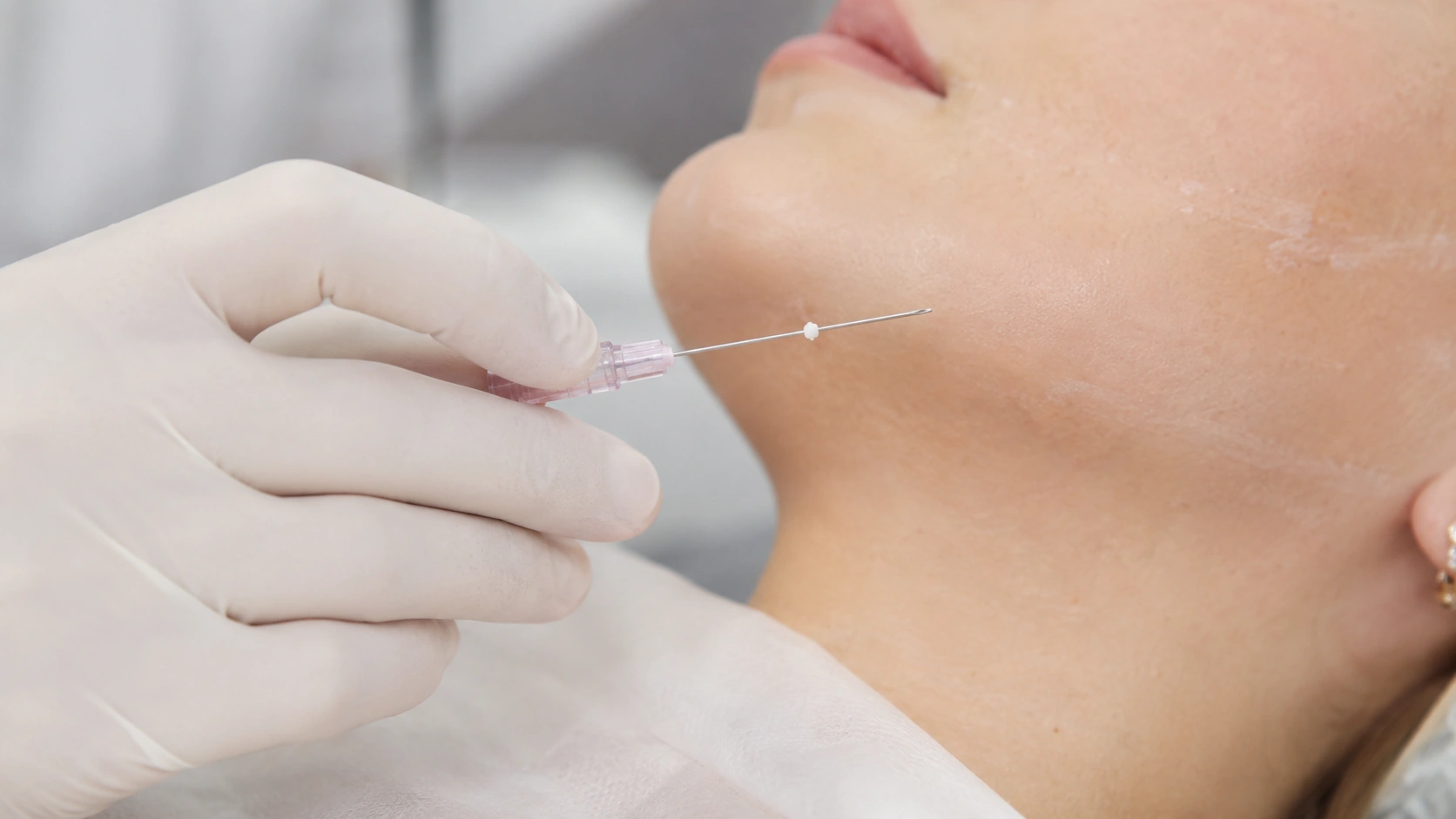 PDO thread lift cannula prepared for placement along the jawline
