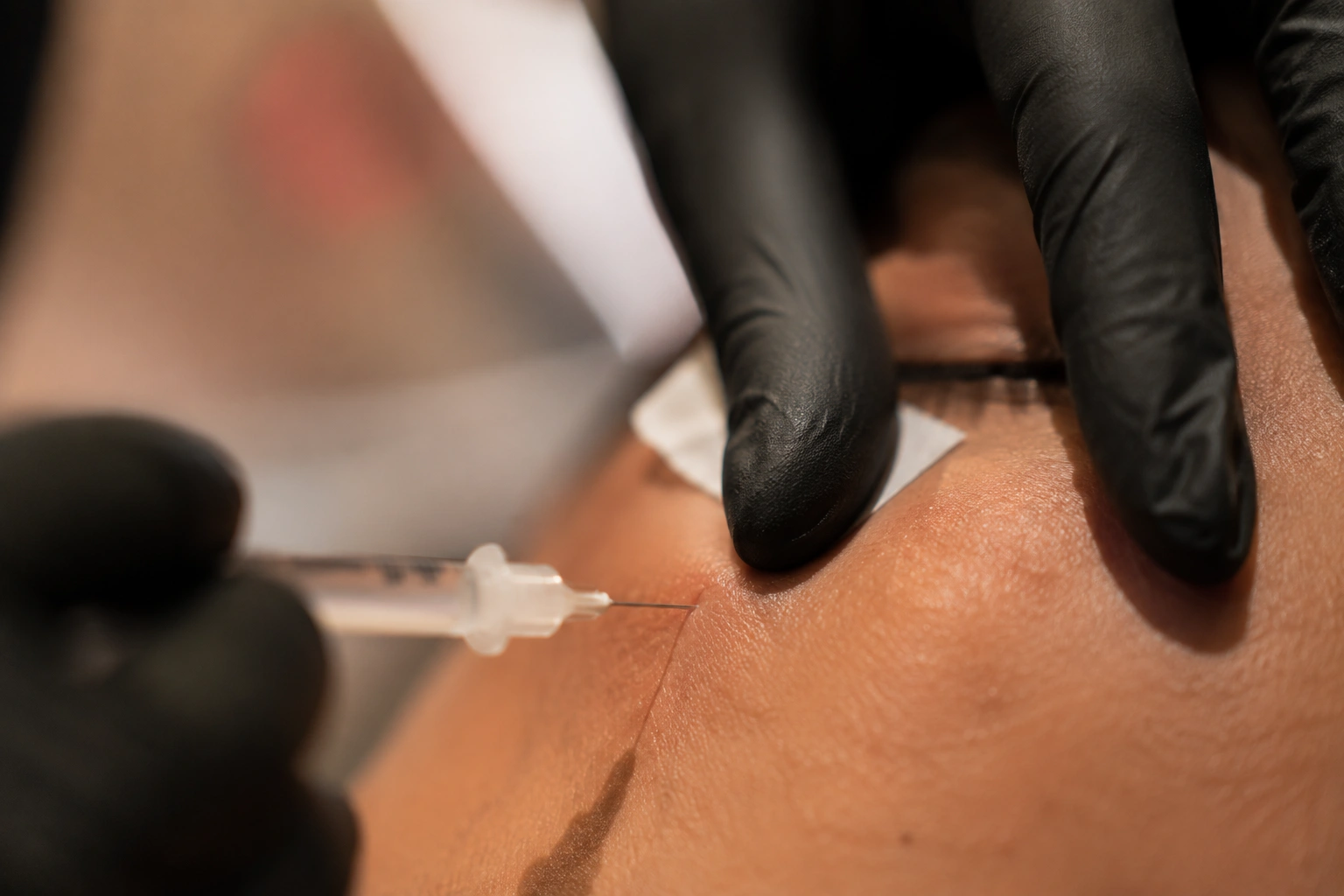 PRP and PRF injection at Skin Works Medical Spa