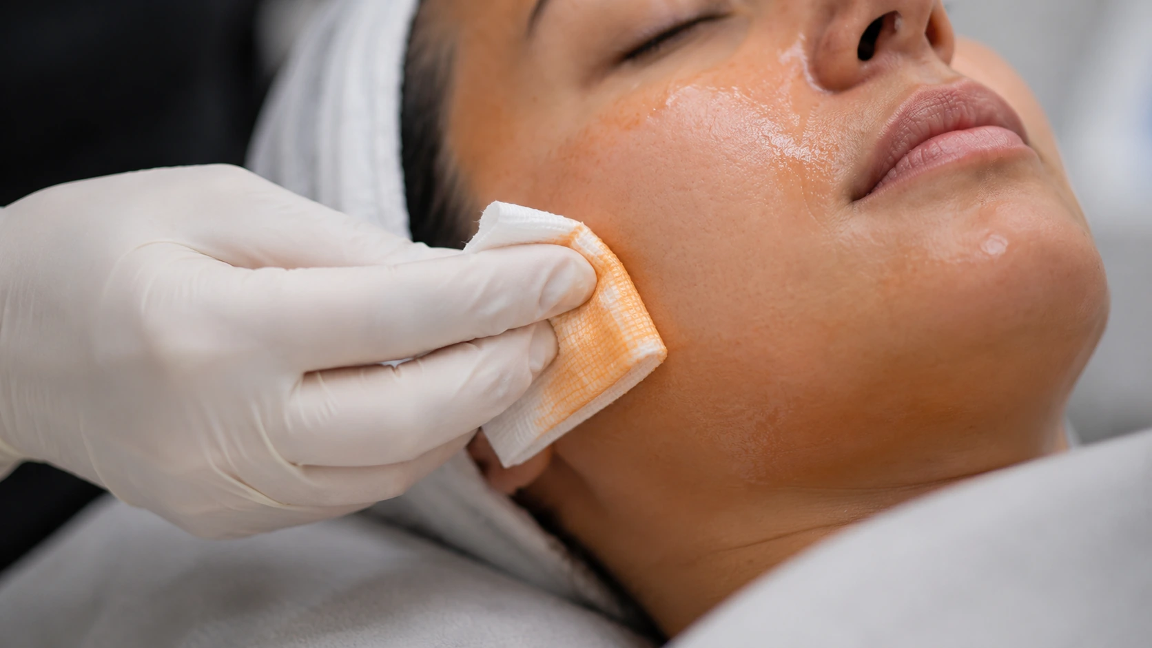 Close-up of VI Peel solution being applied with gauze during treatment