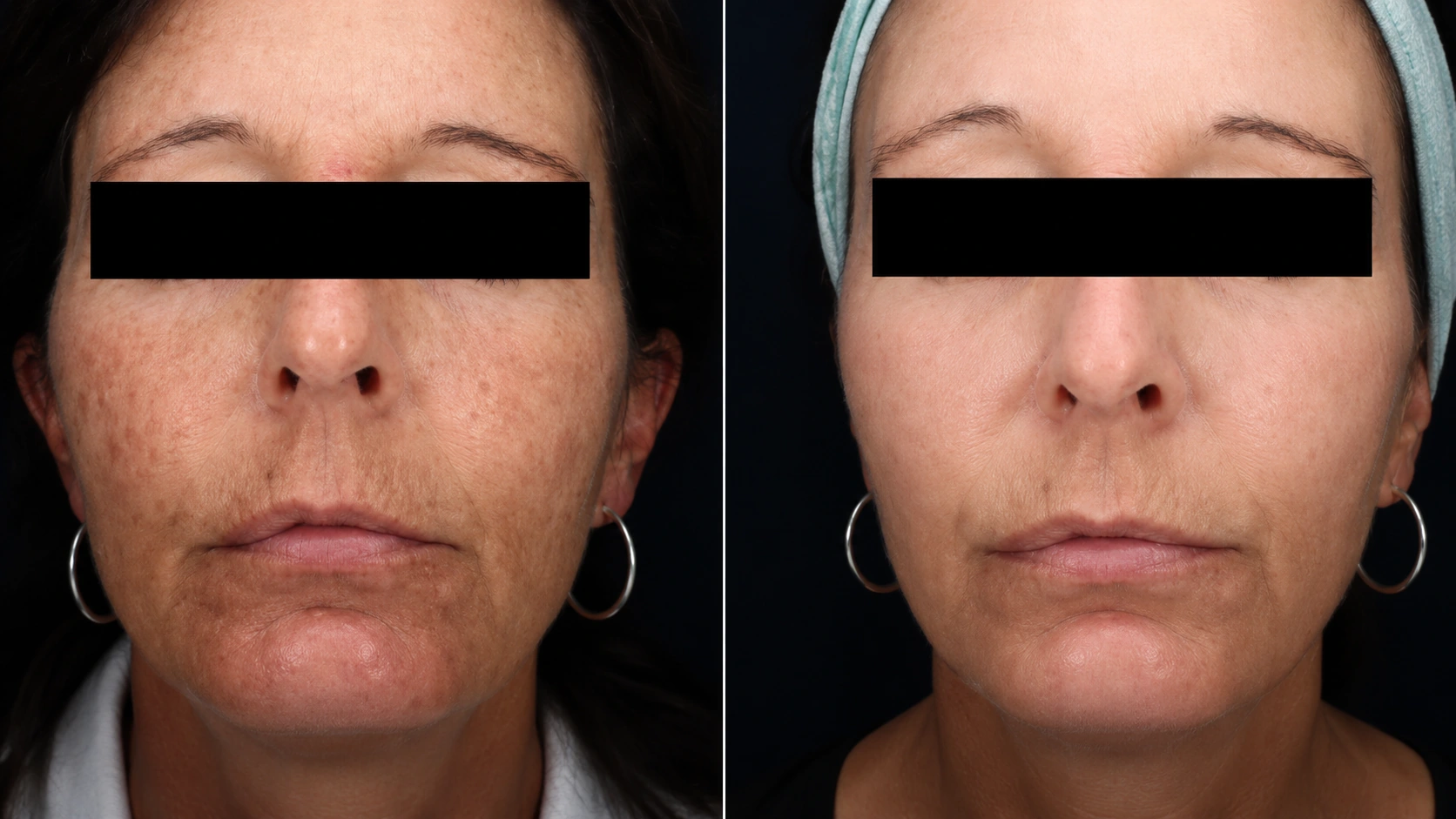 Skin rejuvenation result after a series of pico laser sessions