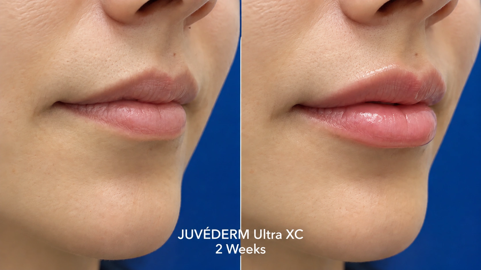 Before and after JUVEDERM Ultra Plus XC lip filler treatment in Torrance