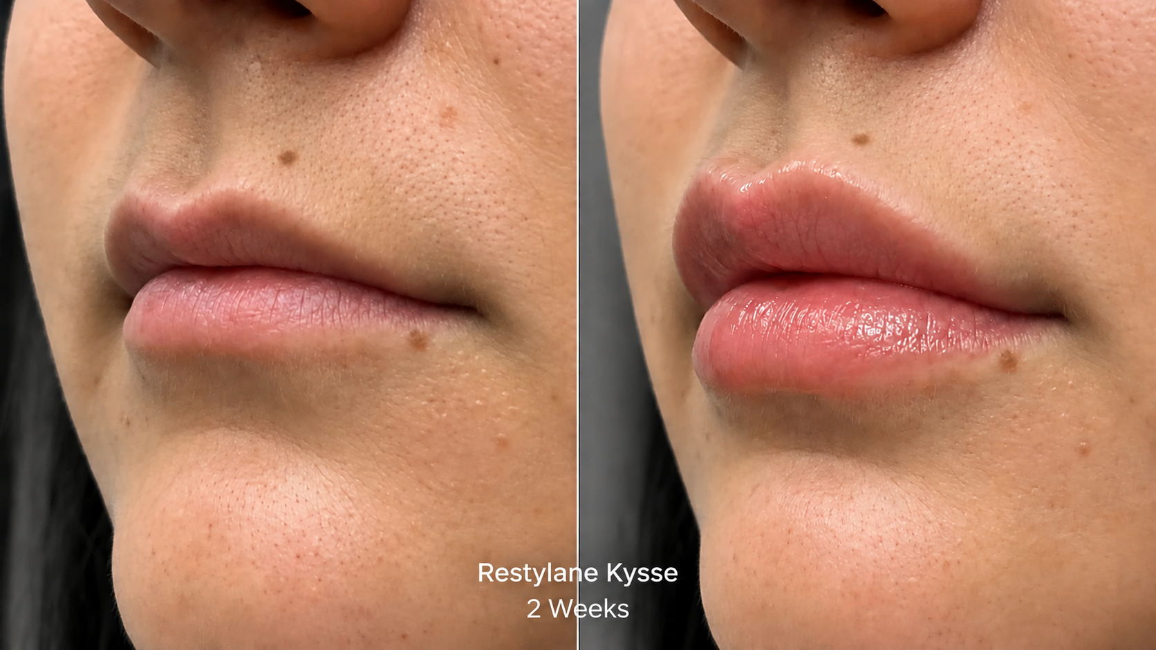 Before and after Restylane Kysse lip filler in Torrance