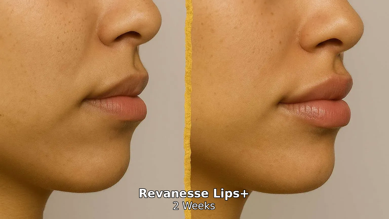 Before and after Revanesse Lips Plus lip filler in Torrance